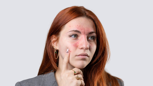 Struggling with Eczema? Red Light Therapy Might Be Your Skin’s New Best Friend